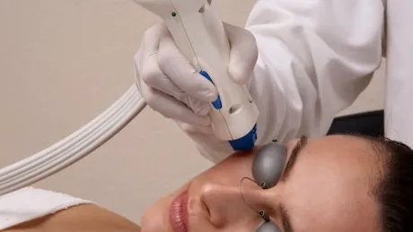 Un ten curat cu peeling-ul laser, o metodă eficientă de exfoliere a pielii