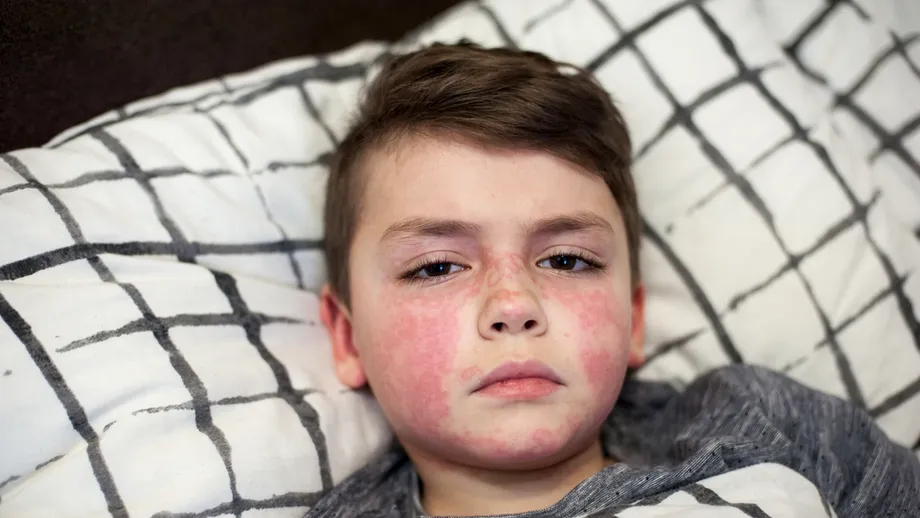 Scarlatina – cum să recunoști infecția bacteriană la copii