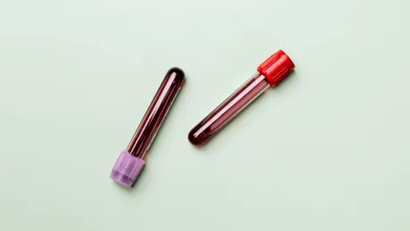 Depistarea cancerului, posibilă cu un test de sânge