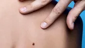 Aluniţe suspecte? Mergi la control, e gratis!