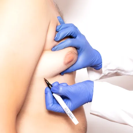 Și bărbații pot face cancer de sân. Care sunt simptomele și factorii de risc