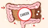 4 boli care cresc riscul de cancer de colon. Ce analize se fac preventiv