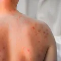 Descoperire majoră în lupta împotriva rujeolei. Cercetătorii au găsit anticorpi capabili să prevină și să trateze infecția