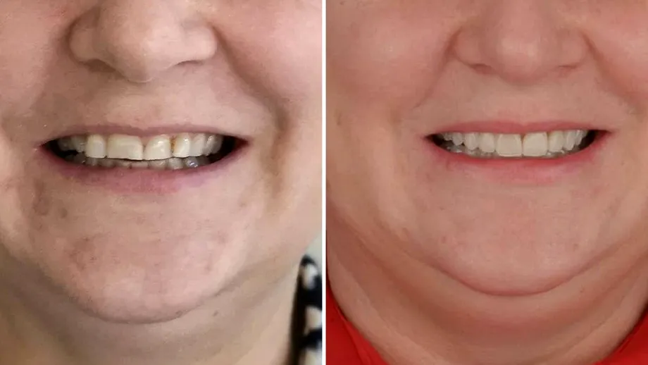 Când dinții nu mai stau la locul lor: de ce uneori ortodonția e esențială înainte de o lucrare dentară