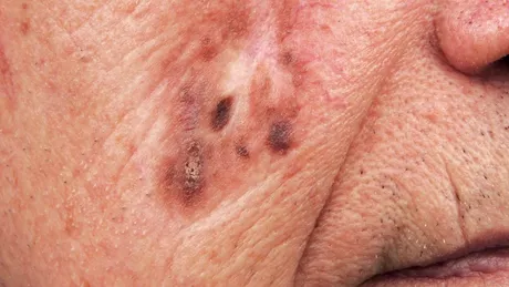 Cancerul de piele mutilează! Medic: Mulți pacienți se tem de operație, deși au rămas fără o nară, o ureche sau o pleoapă