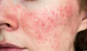 Boala „bujorilor în obrăjori”. De ce apare acneea rozacee și cum se tratează