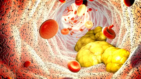 Cum să elimini natural colesterolul rău și să cureți de grăsime vasele de sânge