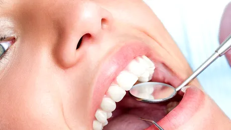 Extracţiile dentare: când se recomandă VIDEO by CSID