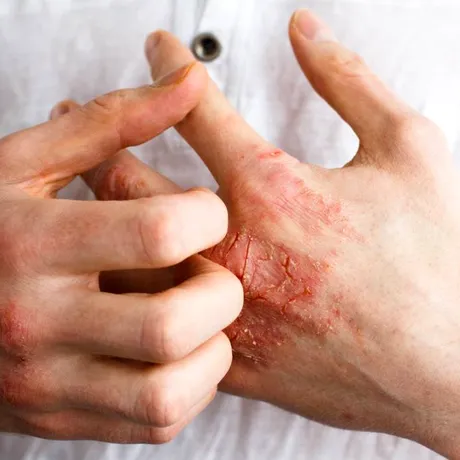 Cum își pot gestiona pacienții cu psoriazis simptomele în sezonul rece. Recomandările medicului dermatolog