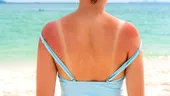Cum îți calmezi arsurile solare. Amestecul care te scapă de usturimea insuportabilă