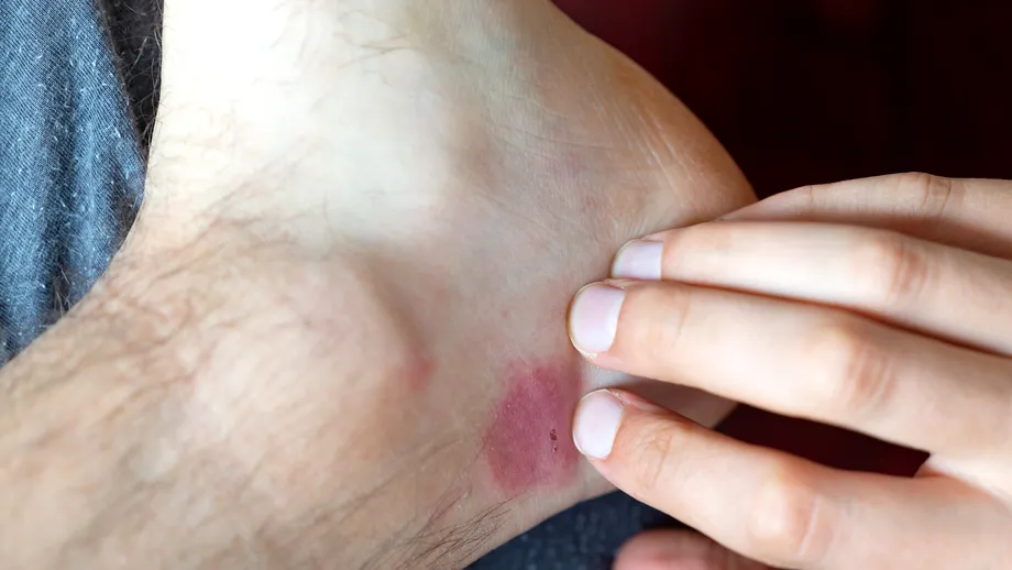Cele mai eficiente remedii pentru mușcătura de purice. Cum scapi rapid de roșeață și mâncărime