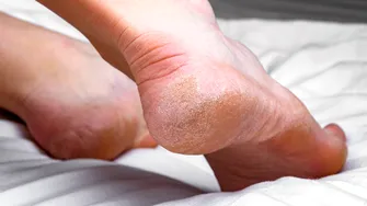 Trucul uimitor pentru călcâie fine. Ai nevoie de un singur ingredient, iar până mâine pielea ta va fi mătăsoasă
