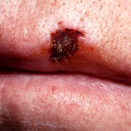 Medic, despre cancerul de piele: Arată ca o pată roz, aspră la atingere, acoperită de o cojiță care nu se vindecă