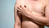 Dermatita atopică nu înseamnă doar piele uscată. Simptomul care poate afecta serios viața de zi cu zi