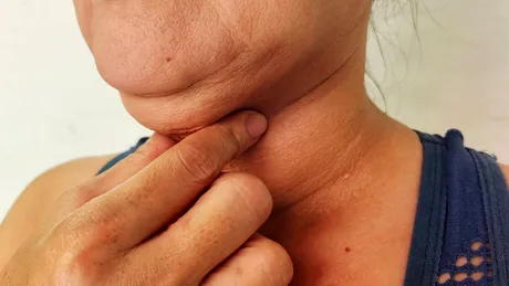 Alimente care au efect gușogen. Stimulează creșterea tiroidei și astfel apare gușa