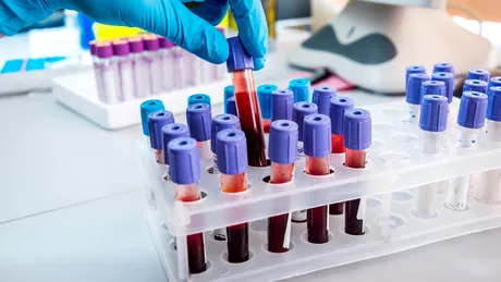 Pot analizele de sânge uzuale să arate un cancer, pentru a fi tratat cât mai repede?