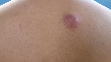 Furuncul: cauze, simptome, complicații, tratament