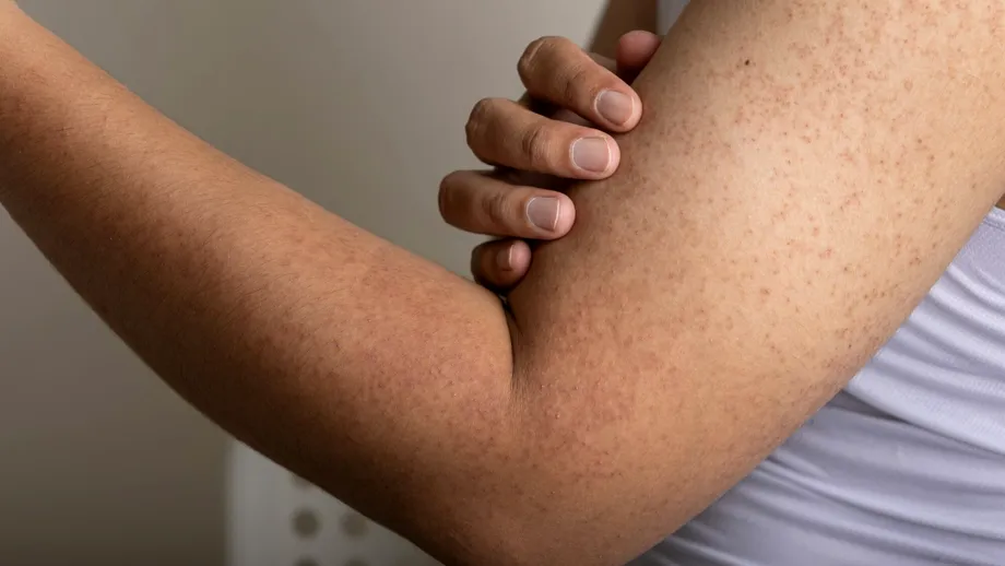 Motivul pentru care apar bubițe roșii pe mâini. 40% din adulți suferă de această boală