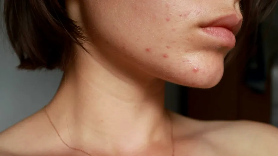 Alimente pe care să le eviți dacă iei acest tratament pentru acnee. Riști complicații severe