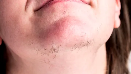 Virilismul (virilizarea): ce este, cauze, simptome, tratament