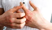 Cum își pot gestiona pacienții cu psoriazis simptomele în sezonul rece. Recomandările medicului dermatolog