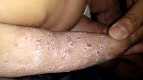 Boala infecțioasă care lasă urme groaznice pe pielea copiilor