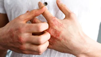 Cum își pot gestiona pacienții cu psoriazis simptomele în sezonul rece. Recomandările medicului dermatolog
