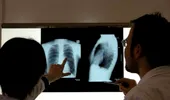 Aproape un sfert dintre români, depistaţi cu probleme pulmonare
