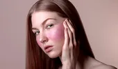 De ce nu dispar acneea și eczema? Medicul spune că răspunsul ar putea fi în intestin