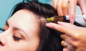 Terapia Vampir, nu doar pentru piele! Cum ajută tratamentul PRP creșterea părului
