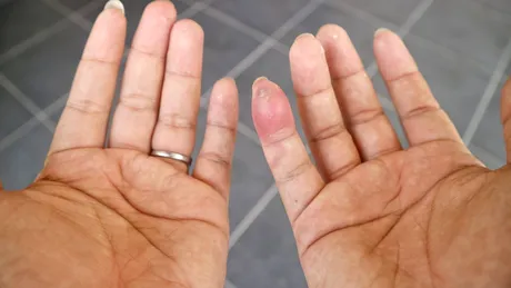 Cum identifici mușcătura de paianjen și cât e de periculoasă