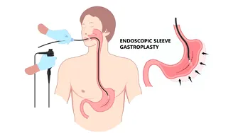 ESG (micșorarea de stomac pe cale endoscopică): alternativa endoscopică pentru slăbire, fără operații invazive