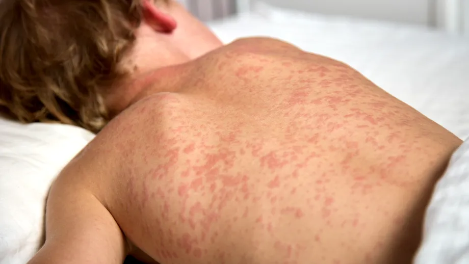 DATE OFICIALE. Care sunt cele mai afectate județe de epidemia de rujeolă