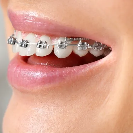 (P) 5 semne clare care indică că ai putea avea nevoie de aparat dentar