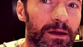 Actorul Hugh Jackman operat pentru a cincea oară pentru extirparea unor celule canceroase