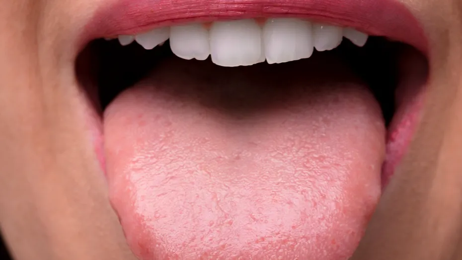 Umflarea limbii, un nou simptom COVID