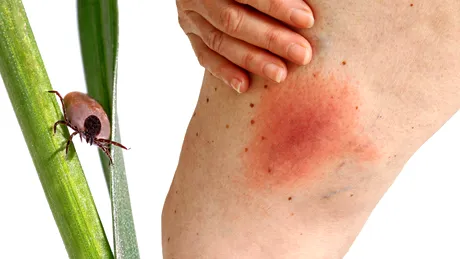 Cum arată mușcătura de căpușă. Semnele care o deosebesc de înțepătura de țânțar