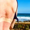 5 remedii naturale care calmează rapid arsurile solare. Ce poți aplica imediat pe piele