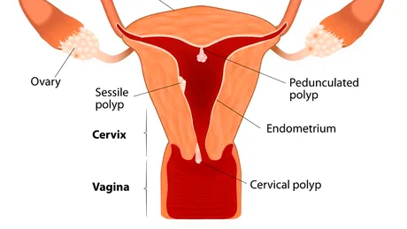 Polip uterin: simptome, tratament