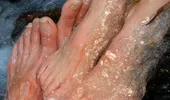 Bolile de piele, tratate cu apele sulfuroase. Cum ameliorăm psoriazisul