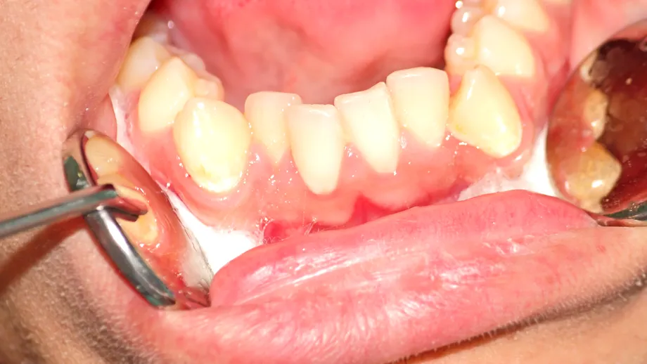Problemele de poziționare ale dinților și sănătatea: „Copiii care au tendința de a respira oral, la vârstă adultă au o predispoziție pentru hipertensiune”