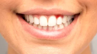 Ce carențe ai dacă îți sângerează gingiile sau îți apar afte
