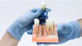 (P) Îngrijirea după implant dentar: reguli simple care pot susține rezultatul pe termen lung