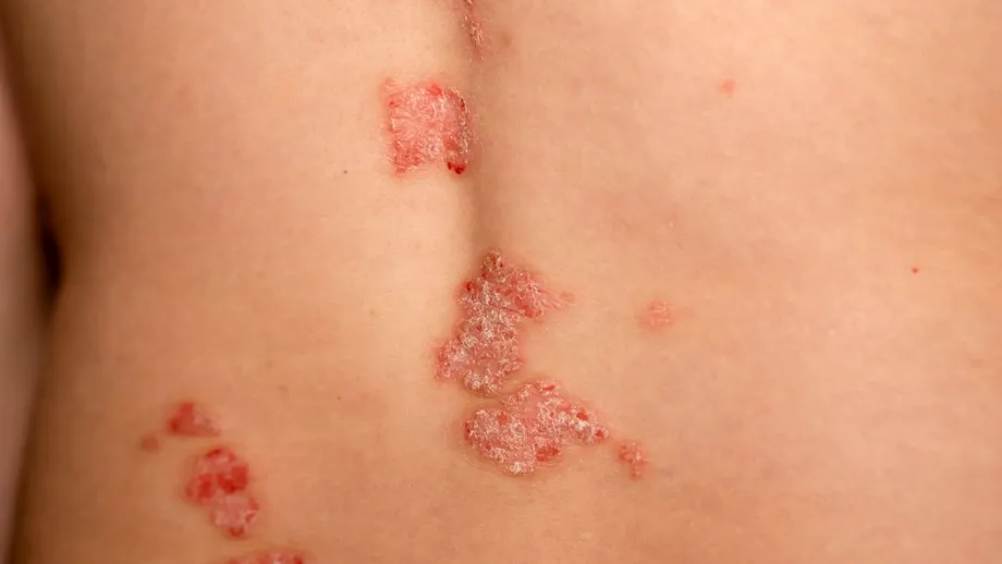 Remedii naturale care pot ajuta în psoriazis. Ce metode au fost studiate și ce trebuie evitat?