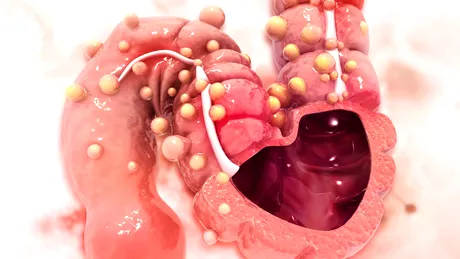 7 semne că ești expus unui risc mare de a dezvolta cancer de colon