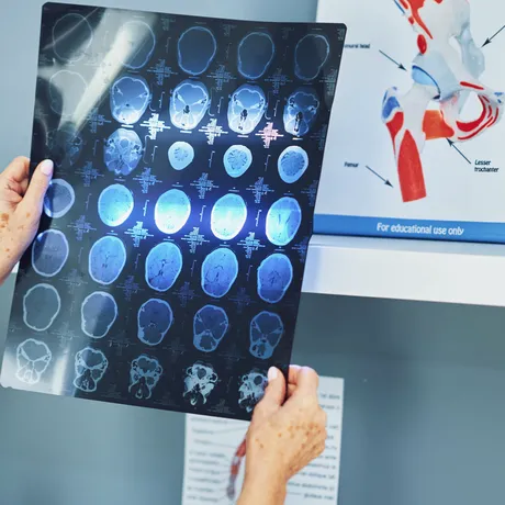Avertisment pentru pacienții cu demență! Medicamentul care crește riscul de AVC