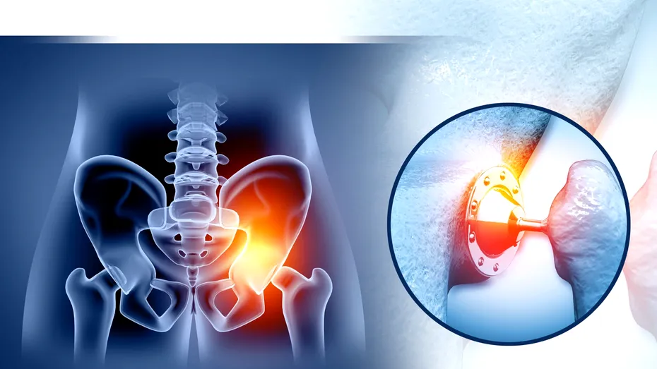 Proteza totală de șold, soluția modernă pentru redobândirea mobilității