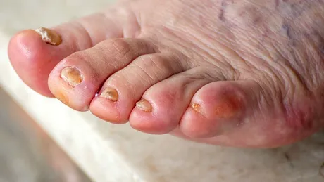 Panariţiul: ce este, cauze, simptome, tratament