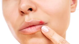 Herpes: Remedii naturale pentru ameliorarea simptomelor și accelerarea vindecării