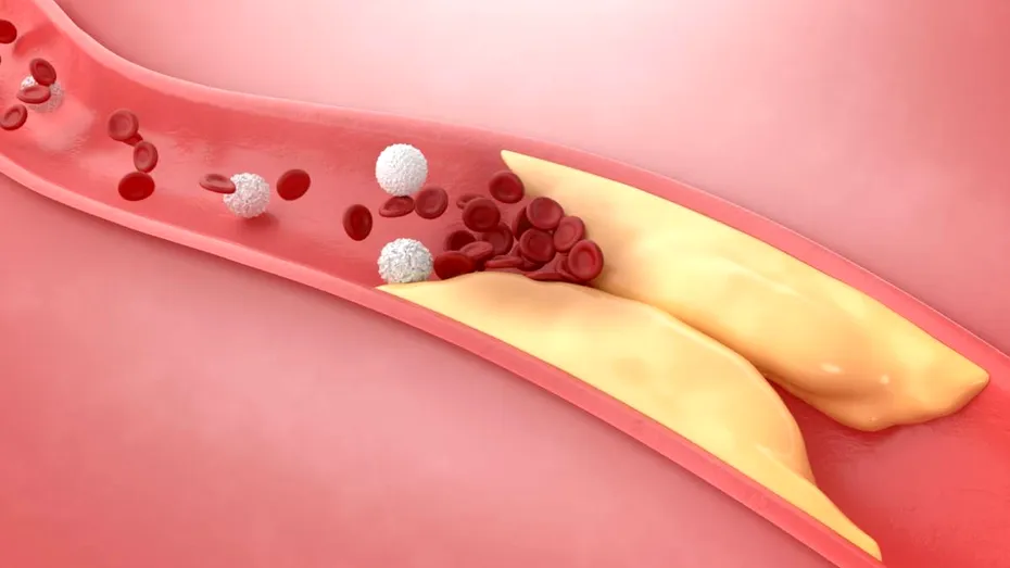 Dieta care curăță arterele de colesterolul în exces. „Face curățenie” în vasele de sânge